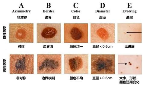 痣出血|黑痣一旦出血会是恶变吗